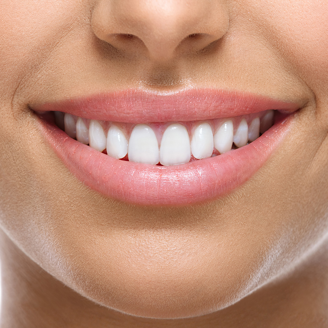 Teeth Whitening in Rickmansworth