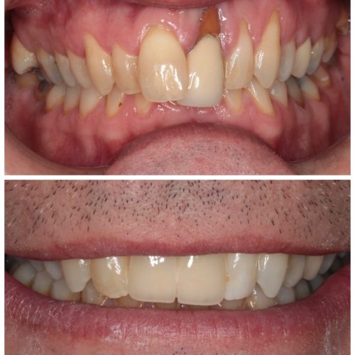 Two single implants