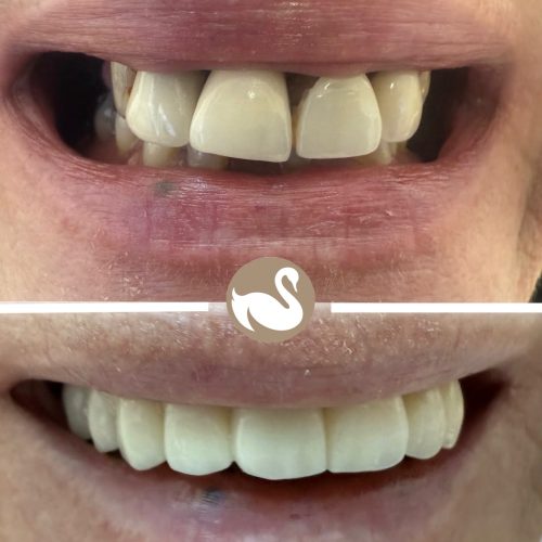 Upper full arch Implants teeth in a day (All on 4)-picture 1