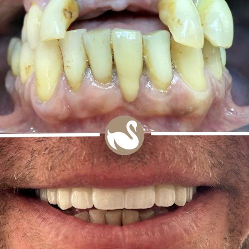 Upper full arch Implants teeth in a day (All on 4)-picture 2
