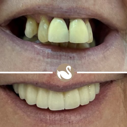 Upper full arch Implants teeth in a day (All on 4)-picture 3