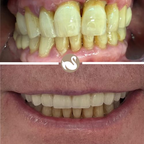 Upper full arch Implants teeth in a day (All on 4)-picture 4
