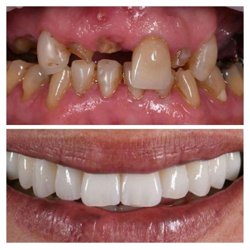 before after dental implant 5
